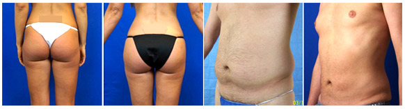 WaterLipo® (Water-Jet Assisted Liposuction) - Before and After Gallery