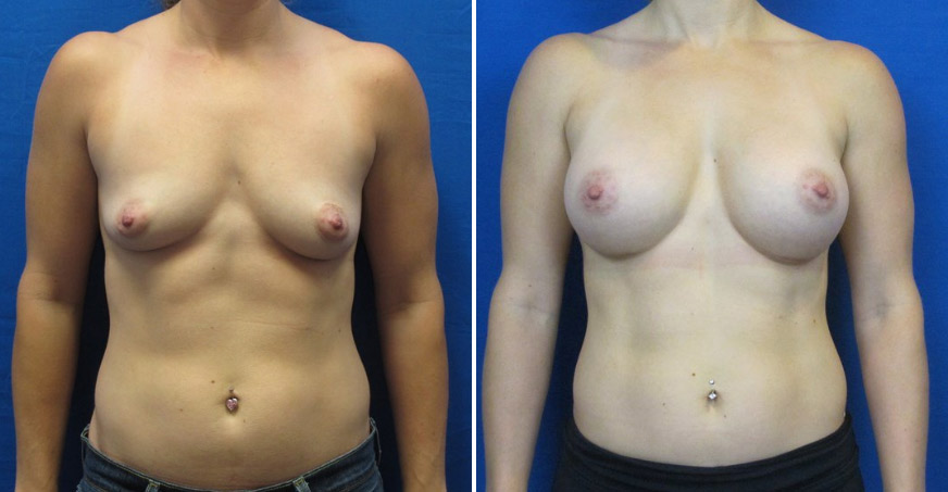 Breast Enhancement Patient 01