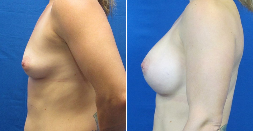 Breast Enhancement Patient 02