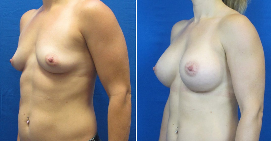 Breast Enhancement Patient 04