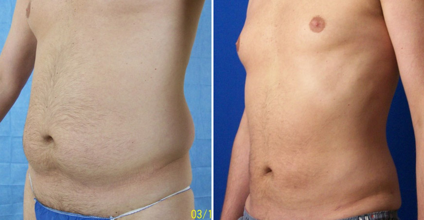 Liposuction Patient 01