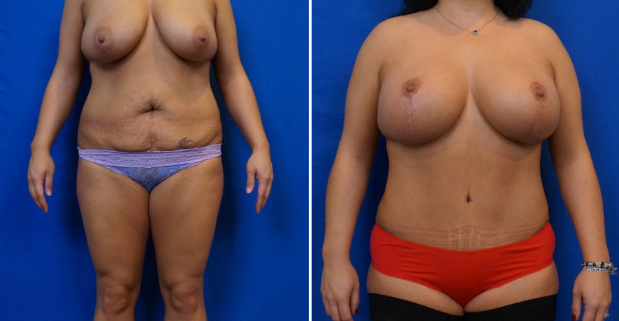 Liposuction Patient 03