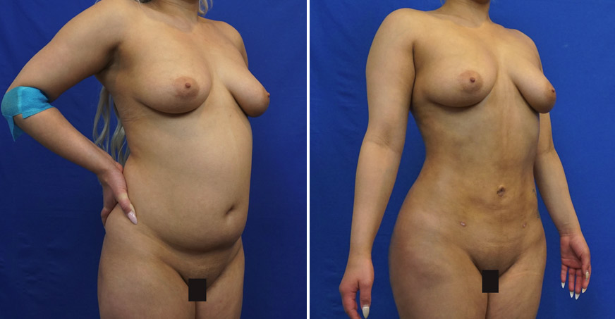 Liposuction Patient 01