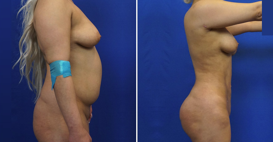 Liposuction Patient 01