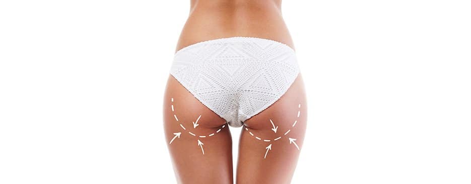 Hip or Buttock Liposuction