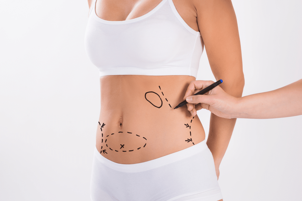 History Of Liposuction