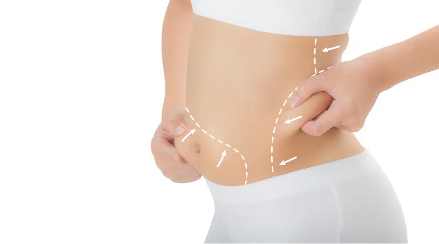 Flank / Love Handle Liposuction - Vegas Liposuction