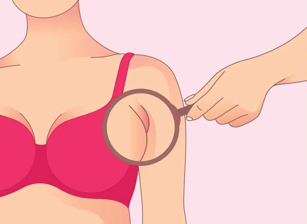 Liposuction for Armpit Fat Your Guide to a Confident Look Vegas Liposuction